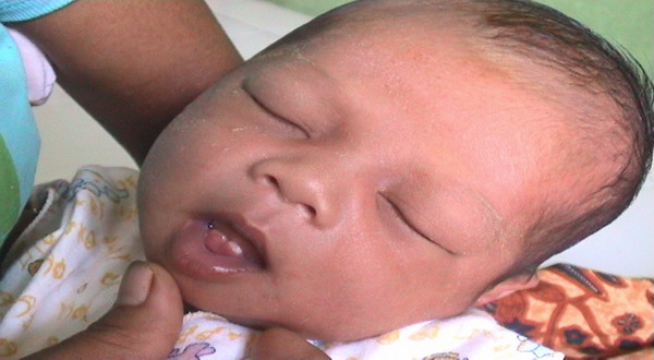 Fenomena Langka, Penyebab dan Dampak Bayi Lahir Sudah Punya Gigi