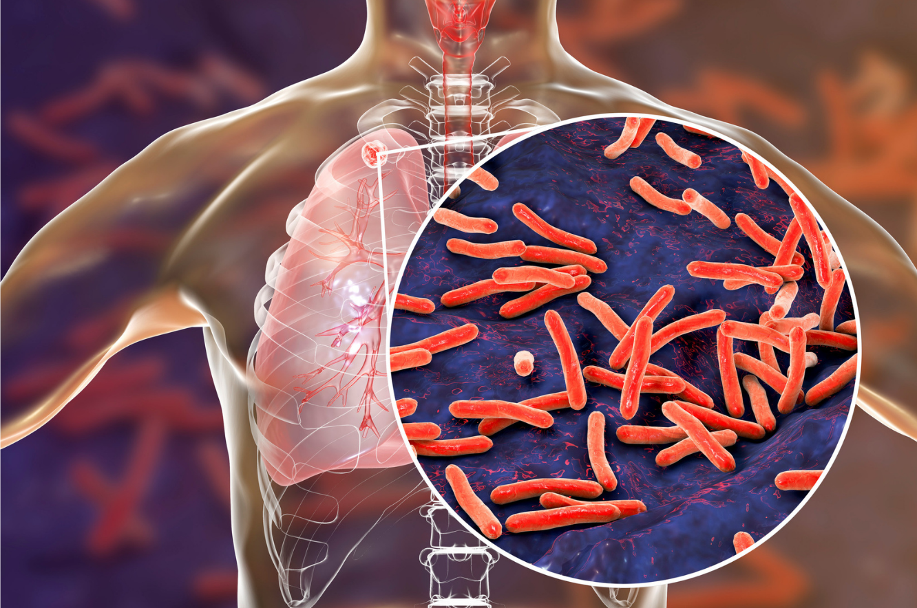 Hari Tuberkulosis Sedunia: Temukan TBC Obati Sampai Sembuh